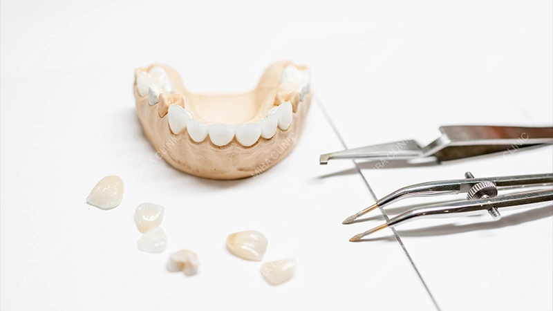 8 Veneers vs 16 Veneers vs 20 Veneers
